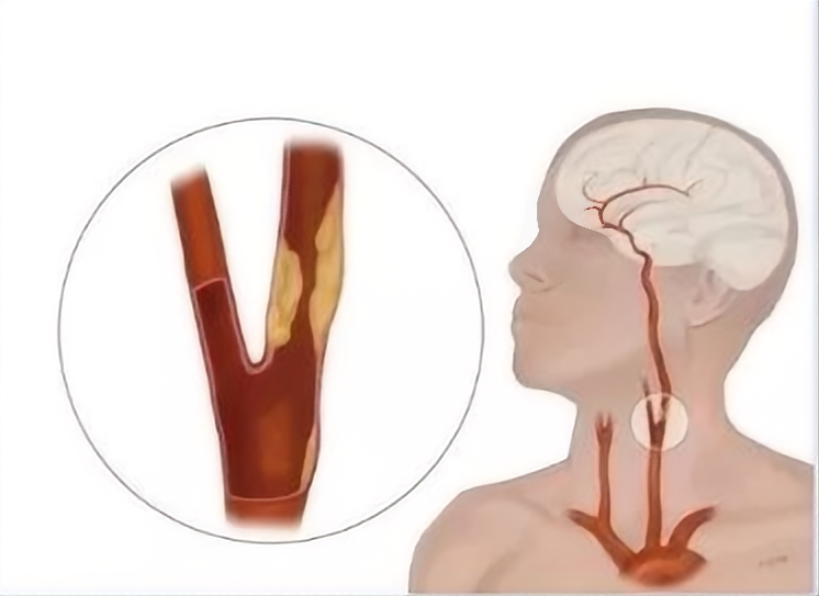 超千万中国人体检结果：两成有颈动脉斑块